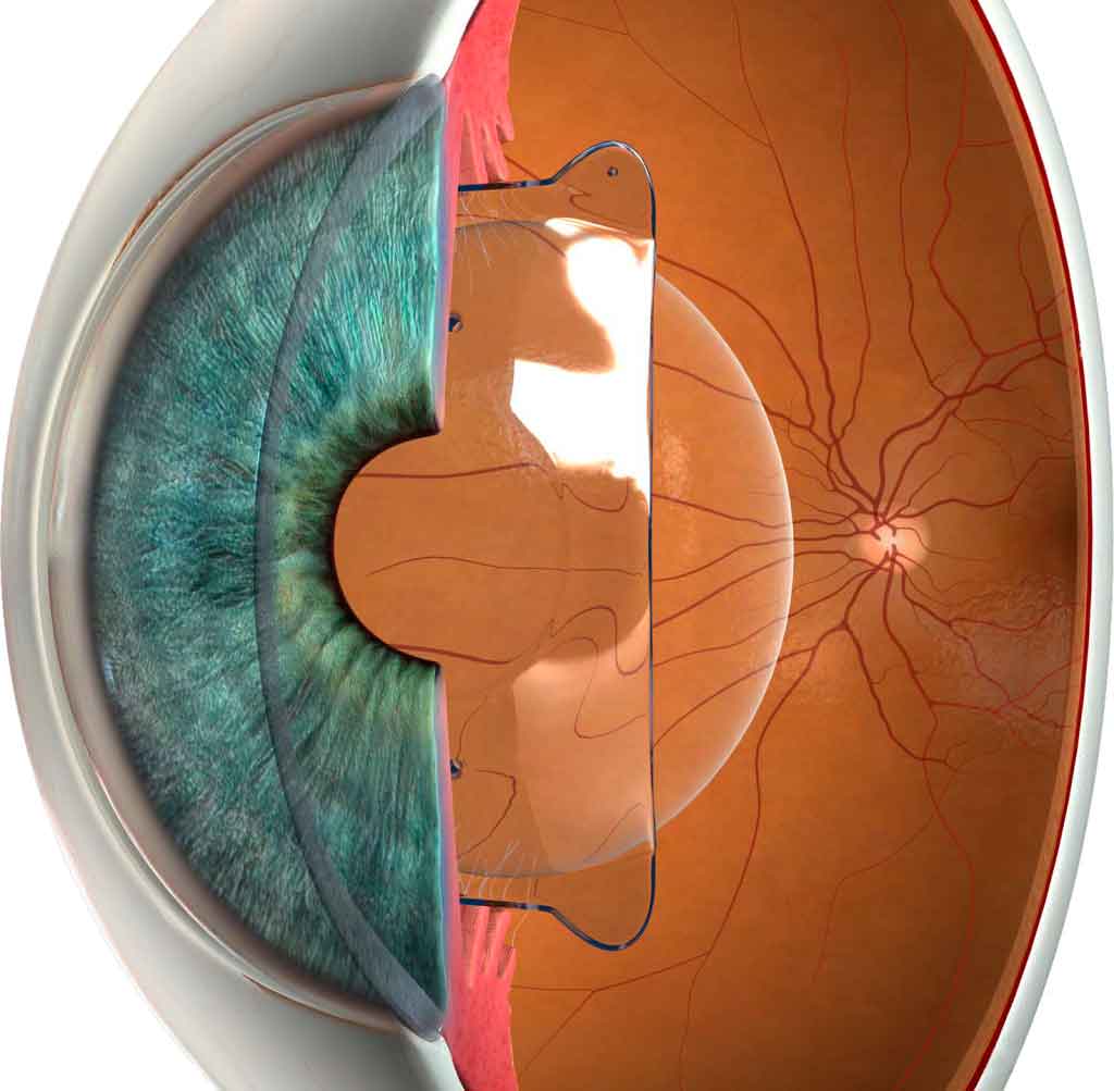 Implantes ICL