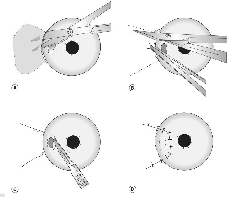 Recubrimiento Conjuntival